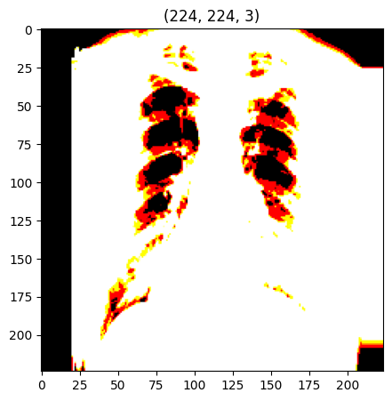 Chest X-ray image showing signs of COVID-19 infection